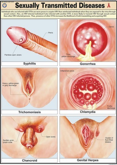 Hati-hati Dengan Penyakit Menular Seksual (PMS) Gonore